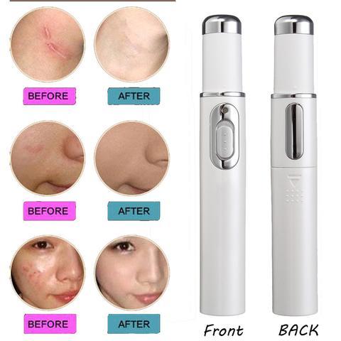 Blue Light Therapy Acne Pen for Soft Scar and Wrinkle Removal - Skin Care Beauty Device